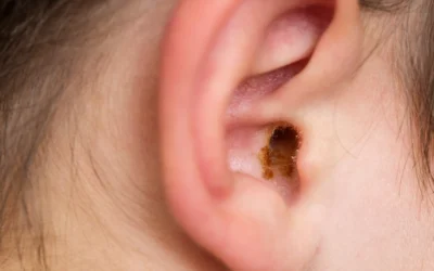 Top 5 Warning Signs of Excessive Earwax Build-Up (and When to Seek Help)